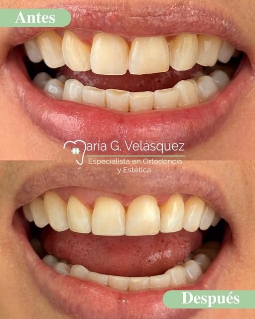 Antes y después de un tratamiento estético